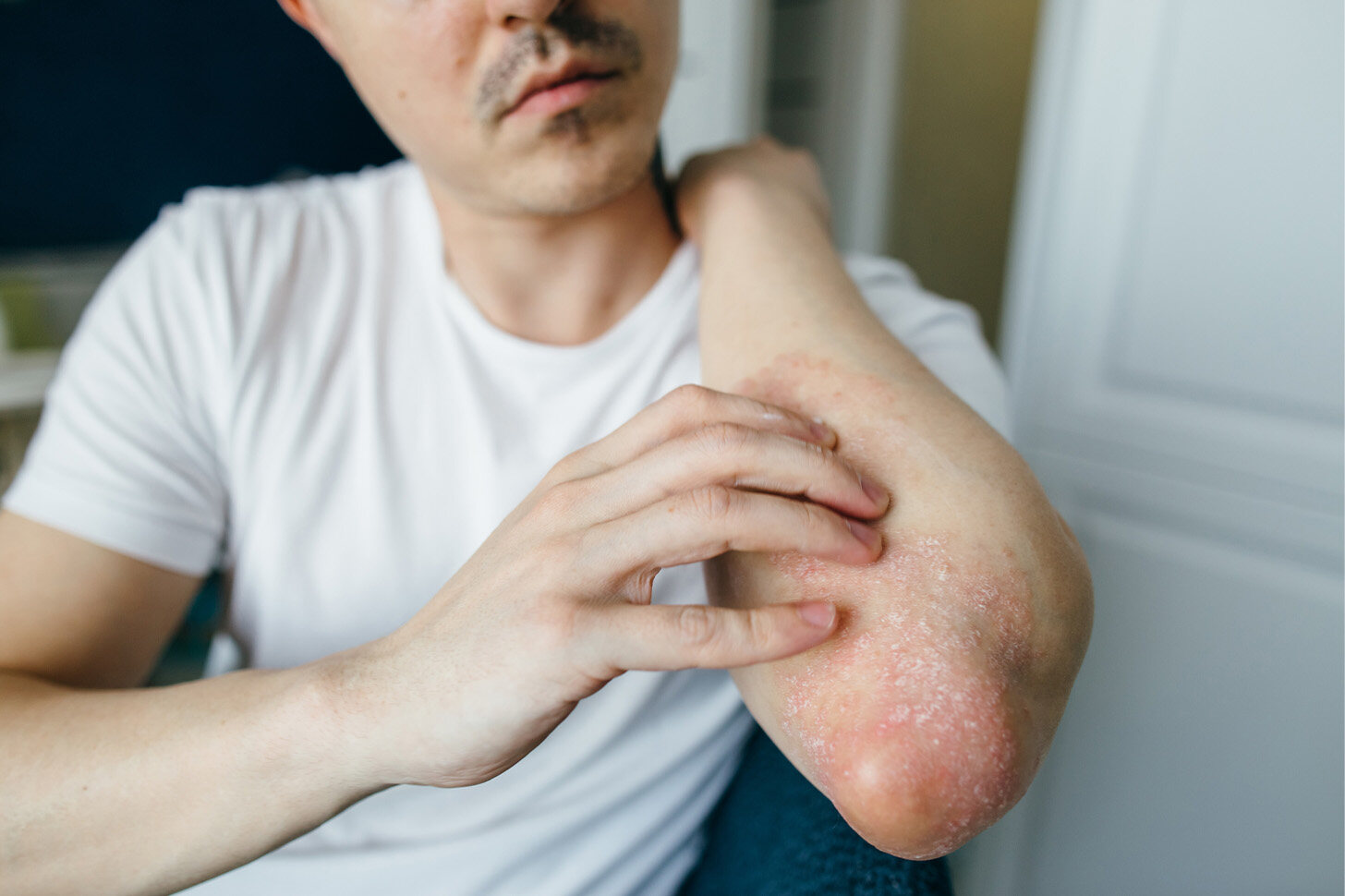 【濕疹抗敏急救潤膚膏推介】10款補濕抗敏急救護膚品推介 紓緩皮膚痕癢+預防敏感 【濕疹抗敏急救潤膚膏推介】10款補濕抗敏急救護膚品推介 紓緩皮膚痕癢+預防敏感