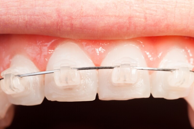 矯正牙齒最常見的就是用不同種類的牙箍，以力學的原理把牙齒拉向正