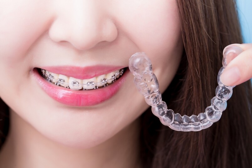 傳統牙箍和透明牙箍都是矯齒科醫生用來矯正牙齒的工具。視乎不同的