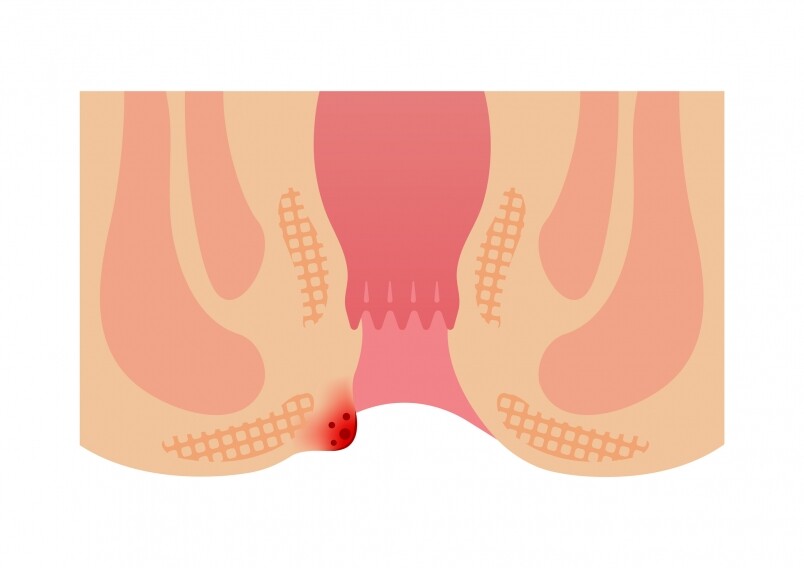 從西醫角度來說，痔瘡是由肛門的細小血管和結締組織形成，而當血液循
