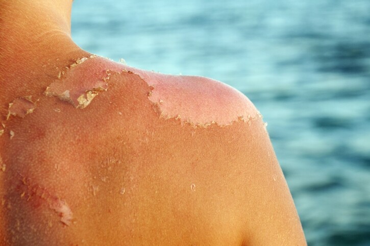 而中波長UVB就可導致曬紅、曬傷和過敏，更會誘發皮膚癌。另外對於愛髮如